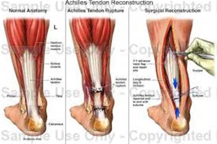 Ахиллово сухожилие где находится у человека на ноге как выглядит фото