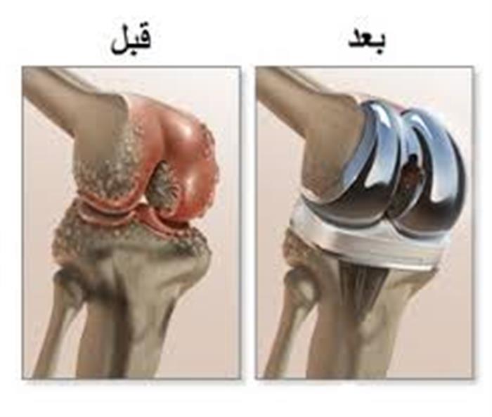 Форум операции по замене суставов. Гонартроз эндопротезирование коленного сустава. Артроз коленного сустава эндопротез. Остеоартроз тазобедренного сустава эндопротез. Титановый эндопротез коленный.