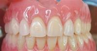 زراعة الأسنان بديلا لطقم الأسنان ولها بعض الشروط