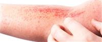 أنواع التهاب الجلد: عديدة وأبرزها الأكزيما 