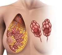  عملية سرطان الثدي 
