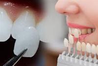  تلبيس الأسنان بعد سحب العصب: أهم المعلومات 