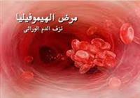  نزف الدم الوراثي (الهيموفيليا): معلومات هامة 