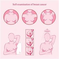 3 طرق للفحص الذاتي لسرطان الثدي