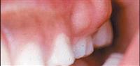 علاج خراج الاسنان