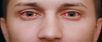  علاج التهاب العين الفيروسي 