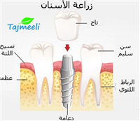 زراعة الأسنان بدون جراحة