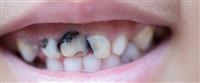 ماذا تعرف عن تسوس الأسنان الأمامية؟ 