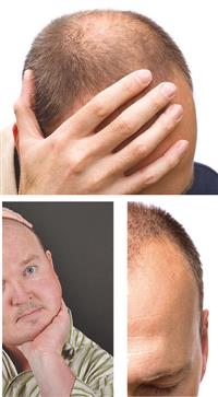 تساقط الشعر عند الرجال.. علاجات متعددة