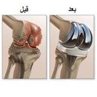  استبدال مفصل الركبة,