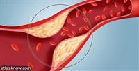الانسداد التام في الأوعية الدموية.