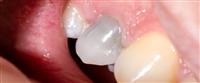 هل يمكن إعادة نمو أسنان جديدة لدى البشر؟