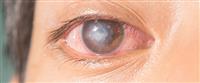 قرحة القرنية: حالة خطيرة قد تصيب العيون 