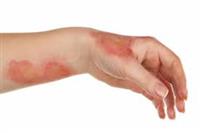 علاج اثار الحروق والندبات في الجلد  