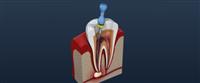 التهاب عصب الأسنان,,