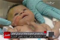 السعودية تشهد حالة ولادة نادرة لطفلة بقلب مكشوف