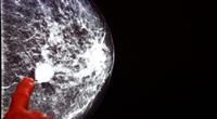 التكنولوجيا المتقدمةوالاكتشاف المبكر لسرطان الثدي.