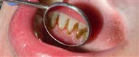 مضاعفات تسوس الأسنان: تعرف عليها 