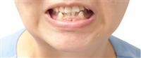 ازدحام الأسنان: مشكلة صحية تداركها قبل أن تتفاقم 