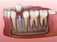 متى تحتاج عملية زراعة الاسنان؟