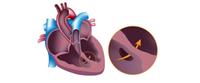 أنواع ثقب القلب عند الأطفال 