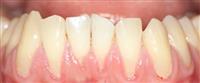 كيف يتم علاج تعري جذور الأسنان ,,,