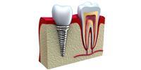 زراعة الأسنان بواسطة الخلايا الجذعية