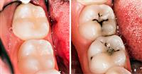 كيف يتم علاج تسوس الاسنان