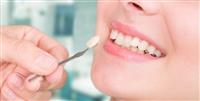 فينير اسنان | ما هي مزايا وعيوب الفينير