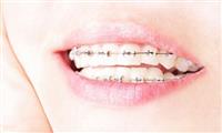 ابحاث تشير إلى أن تقويم الاسنان الثابت افضل و ارخص