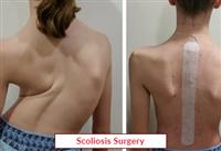 الجَنَف scoliosis