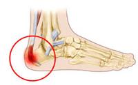 داءُ سيفر Sever Disease