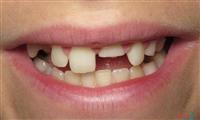 الأسنان المكسورة تعرف على علاجها وأعراضها وأسبابها