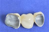 تركيبات الأسنان البورسلين والزيركون