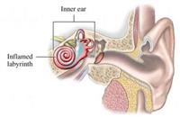 التهاب تية الأذن