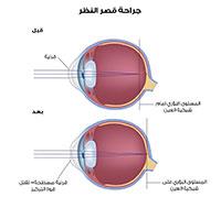  عمليات الليزر للعيون 