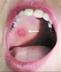 8 بالمائة من الأورام تصيب « الفم واللسان»
