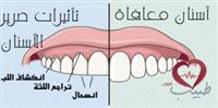 صرير الأسنان Bruxism وصحة الفم