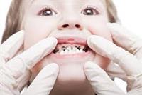 أسنان الطفل : تسوس الأسنان الوقاية والعلاج