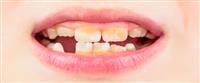  تغير لون أسنان الطفل: الأسباب وأهم النصائح 
